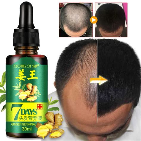 Ginger Germinal Hair regrowth Essential Oil Hair Loss Treatment For Men ...