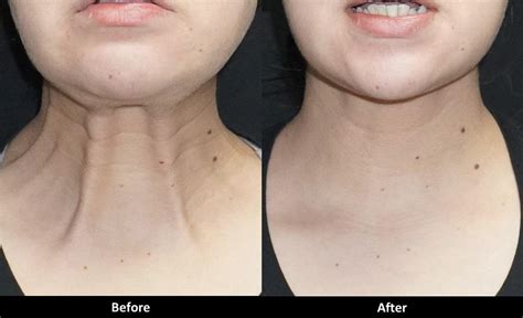 Improve the appearance of your neck