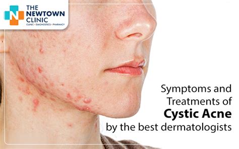 Symptoms and Treatments of Cystic Acne by the best dermatologists