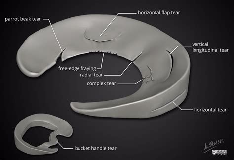 Types of Meniscal Tears