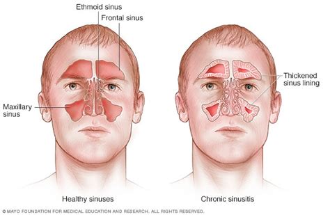 What is a Sinus Infection or Sinusitis and How to Cure it