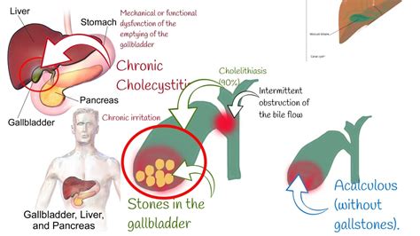 Cholecystitis Signs and symptoms. Chronic and acute Cholecystitis ...