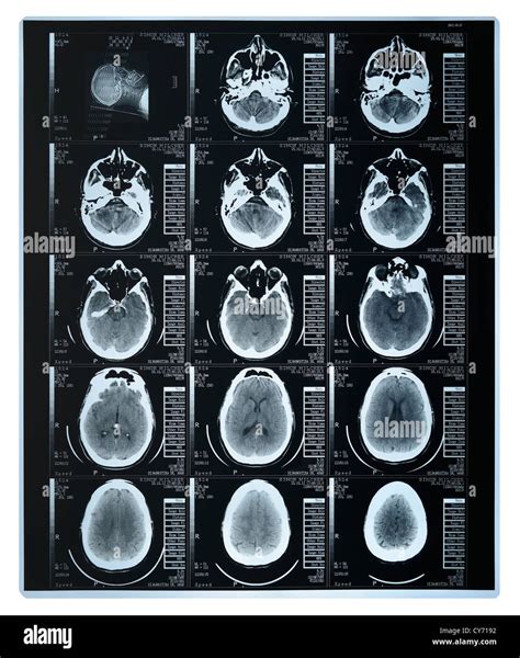 Cat Scan Brain Tumor