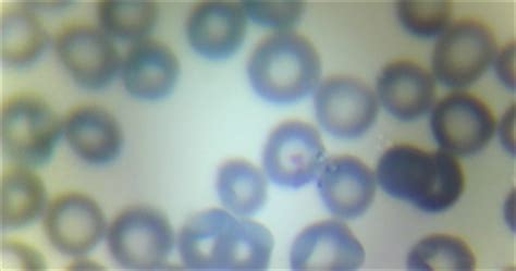 LymeMD: Babesia blood smear results