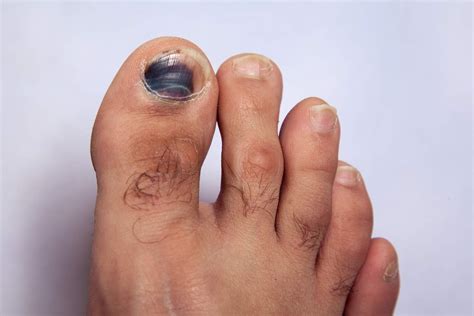 An Overview of Common Toenail Problems