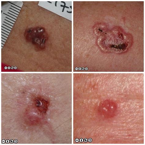 Basal cell carcinoma - Skin Cancer 909