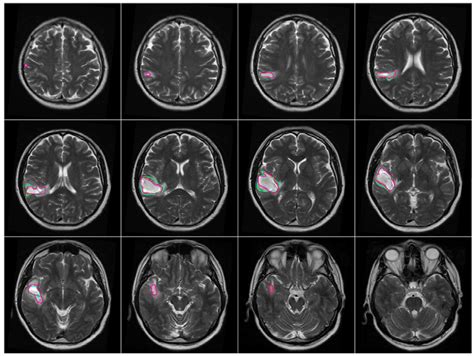 Brain Mri Scan Tumor