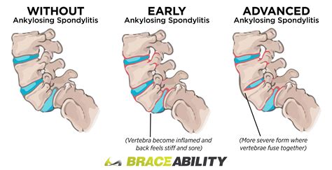 Spondylosis | The Most Confusing Spine Condition Explained