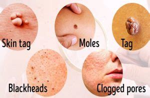 Remove Moles, Warts, Blackheads, Skin Tags and Age Spots with These ...