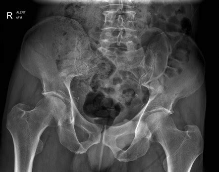 Right iliac wing fracture | Radiology Case | Radiopaedia.org