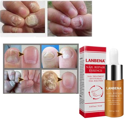 Aliexpress.com : Buy Nail Fungus Treatment / Onychomycosis Paronychia ...