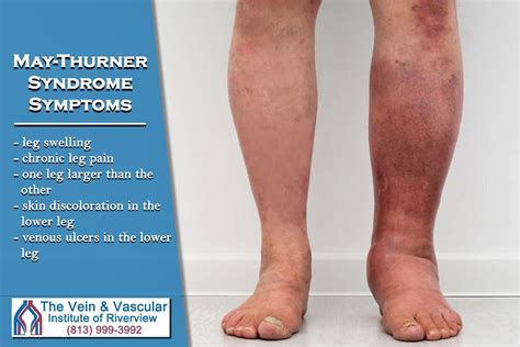 Our board certified vascular surgeons treat May-Thurner Syndrome using ...