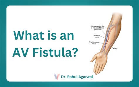 What is an AV Fistula