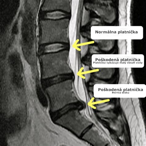 Degeneratívne ochorenie medzistavcových platničiek – Plnohodnotný život