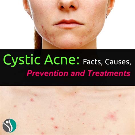 Cystic Acne: Facts, Causes, Prevention, and Treatments ...