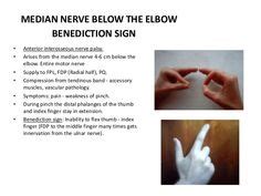 Ape Hand Deformity Splint on Picterest | signs | Pinterest