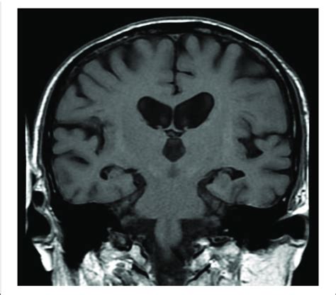 | Medial temporal atrophy (MTA) scoring illustrated on T1-weighted MRI ...