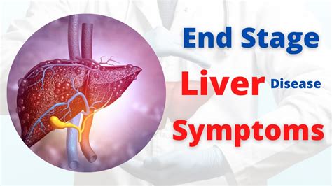 Liver Cirrhosis Final Stages