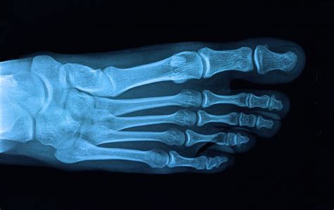 Xray Of Foot With Arthritis