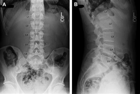 Lumbosacral Transitional Segments - Physical Medicine and ...