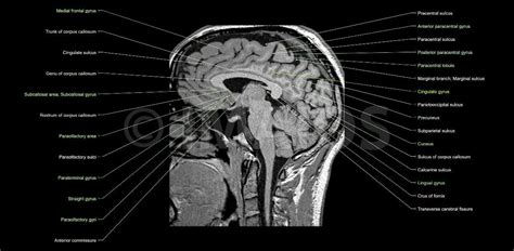 Anatomy of the brain (MRI) | Mri brain, Brain anatomy, Atlas anatomy