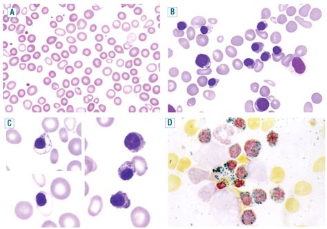 Ring sideroblasts and sideroblastic anemias | Haematologica