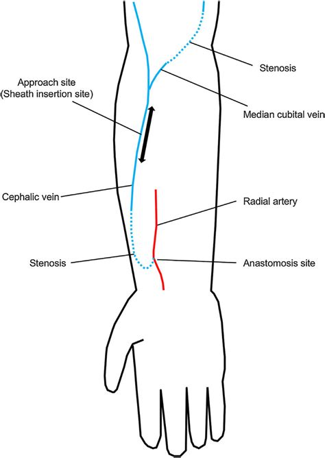 Understanding The Arteriovenous Fistula Azura Vascular Care