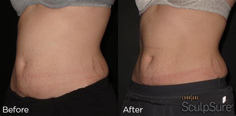 Sculpsure Before and After Photos | Cosmetic Dermatology Knoxville TN