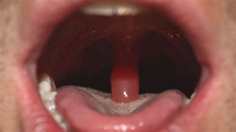 What happens if you have your uvula removed?