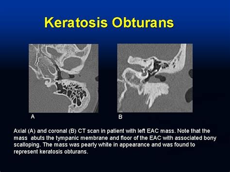 Infectious and Inflammatory Processes of the Temporal Bone