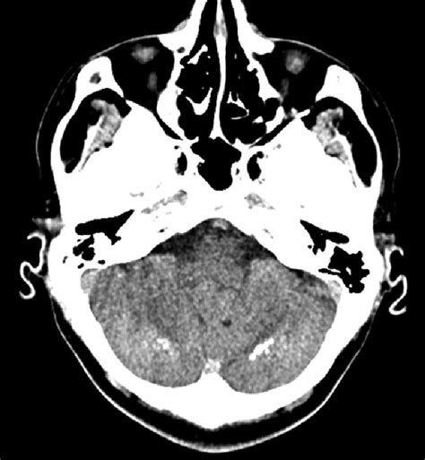 Cerebellar dentate nucleus calcifications. Figure 2. Bilateral ...