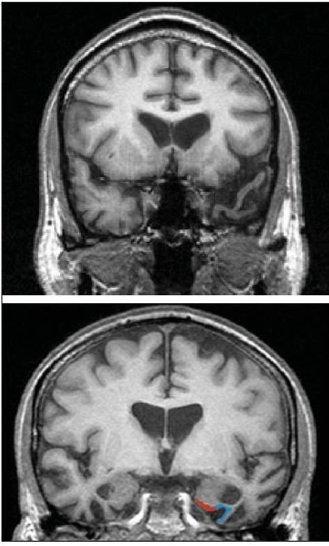 Coronal MRI scans of a patient with SD showing temporal lobe atrophy ...