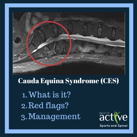 Cauda Equina Syndrome - Back to Active Sports and Spinal - Macquarie Park