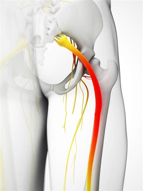 What You Need To Know: Anatomy of the Sciatic Nerve - Spine Center of Texas