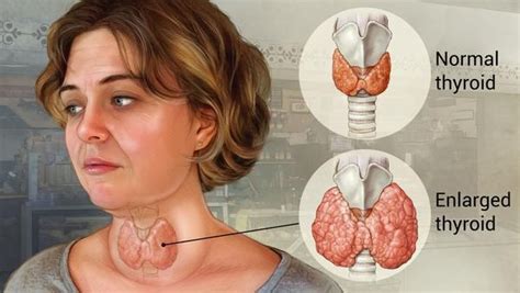 What is a goiter? - Quora