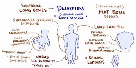 Achondroplasia Mnemonic | Epomedicine