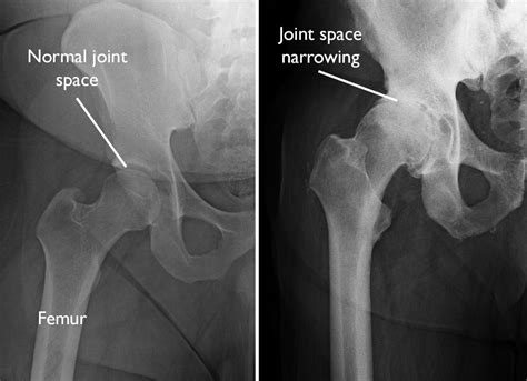 Arthritis: An Overview - OrthoInfo - AAOS