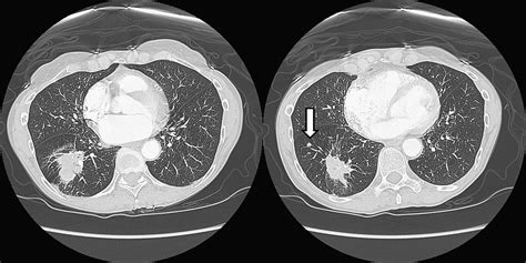 Additional Pulmonary Nodules in the Patient with Lung Cancer ...