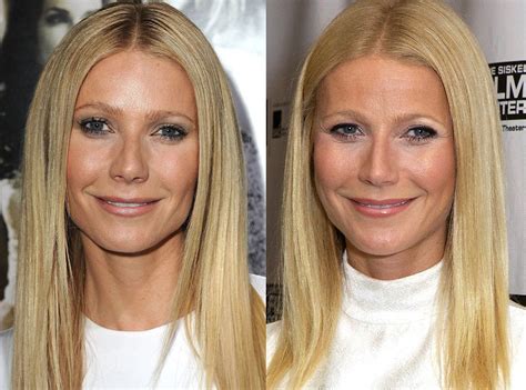 Photos from Better or Worse: Celebs Who Have Had Plastic Surgery - E ...