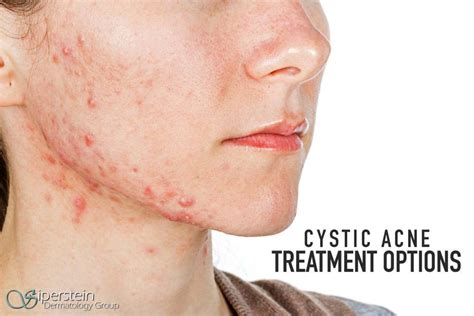 Everything You Need To Know About Cystic Acne Treatment