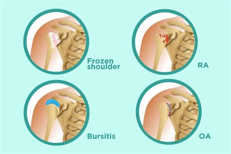 Arthritis in Shoulders: Symptoms, Types of Shoulder Arthritis