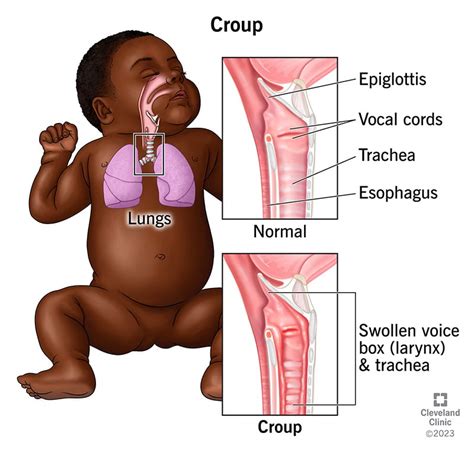 Croup: Causes, Symptoms & Treatment