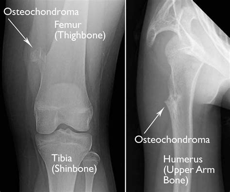 Osteochondroma causes, symptoms, diagnosis & osteochondroma treatment