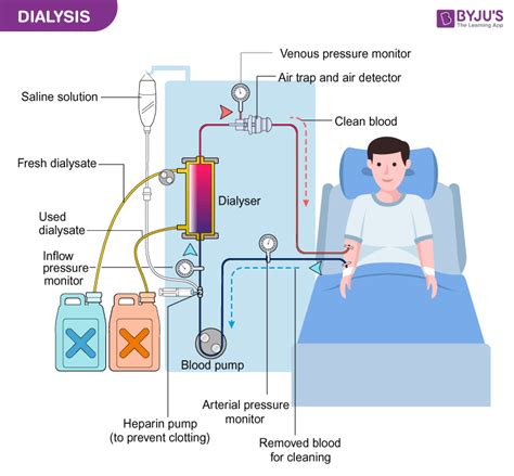 Hemodialysis Diagram