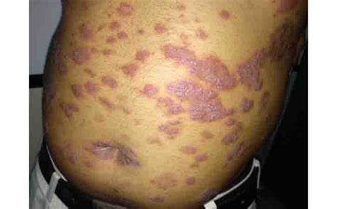 Guttate Psoriasis