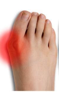 Bump On Foot: Ankle & Foot Centers of Georgia - West Cobb: Podiatric ...