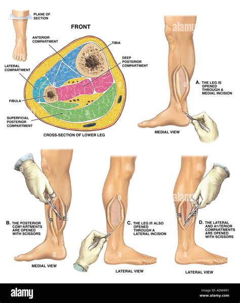 Compartment Syndrome - Motus Physical Therapy