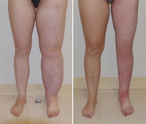 Lipedema vs. Lymphedema | Dr. Jay Granzow, MD