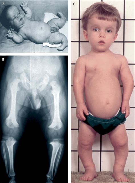 Dwarfism Types Achondroplasia