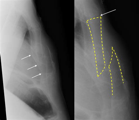 Sternum Fracture